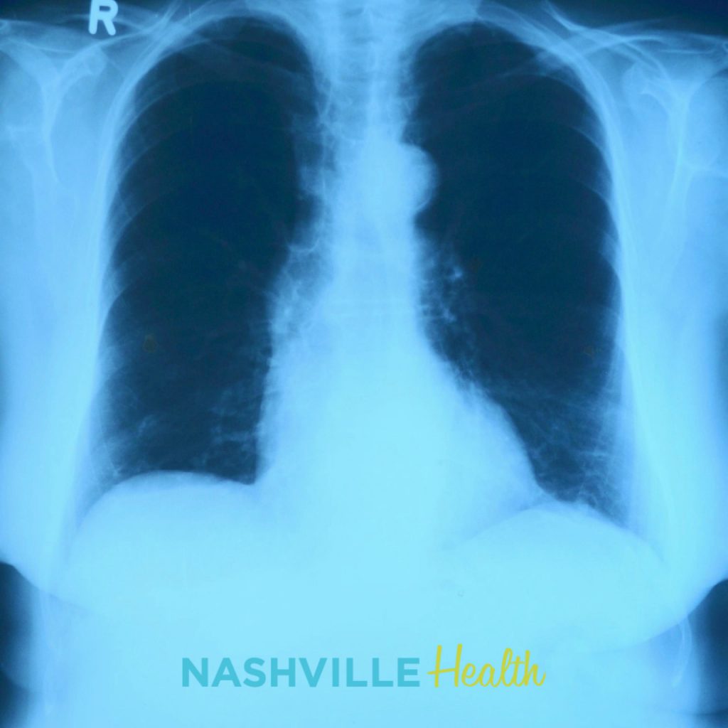 Lung Health after Smoking Cessation